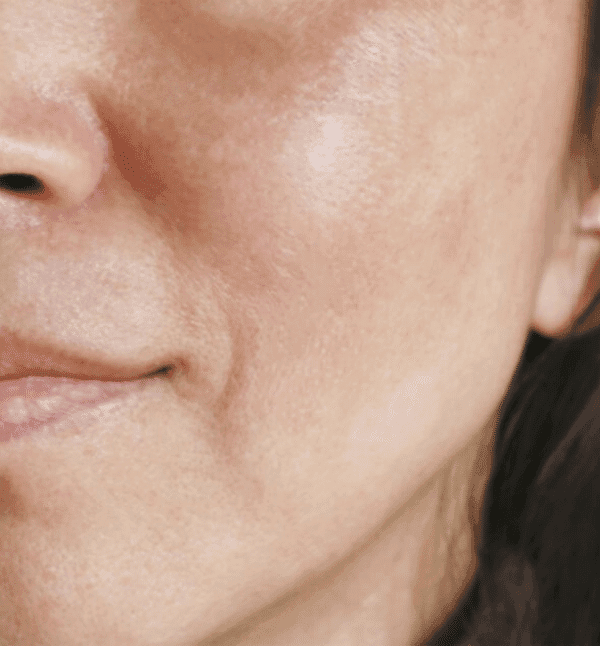 Acne & Pigmentation Treatment — After