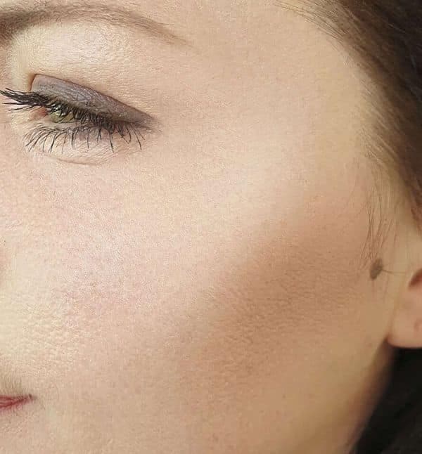 Fine Lines & Wrinkles — After