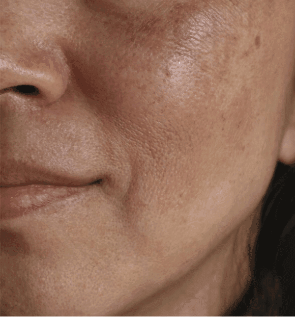 Acne & Pigmentation Treatment — Before