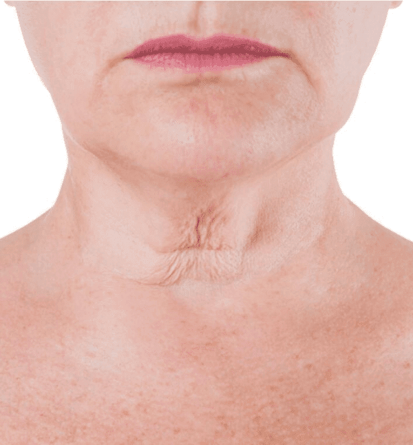 HIFU Skin Tightening — Before