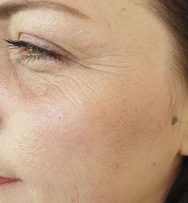 Fine Lines & Wrinkles — Before