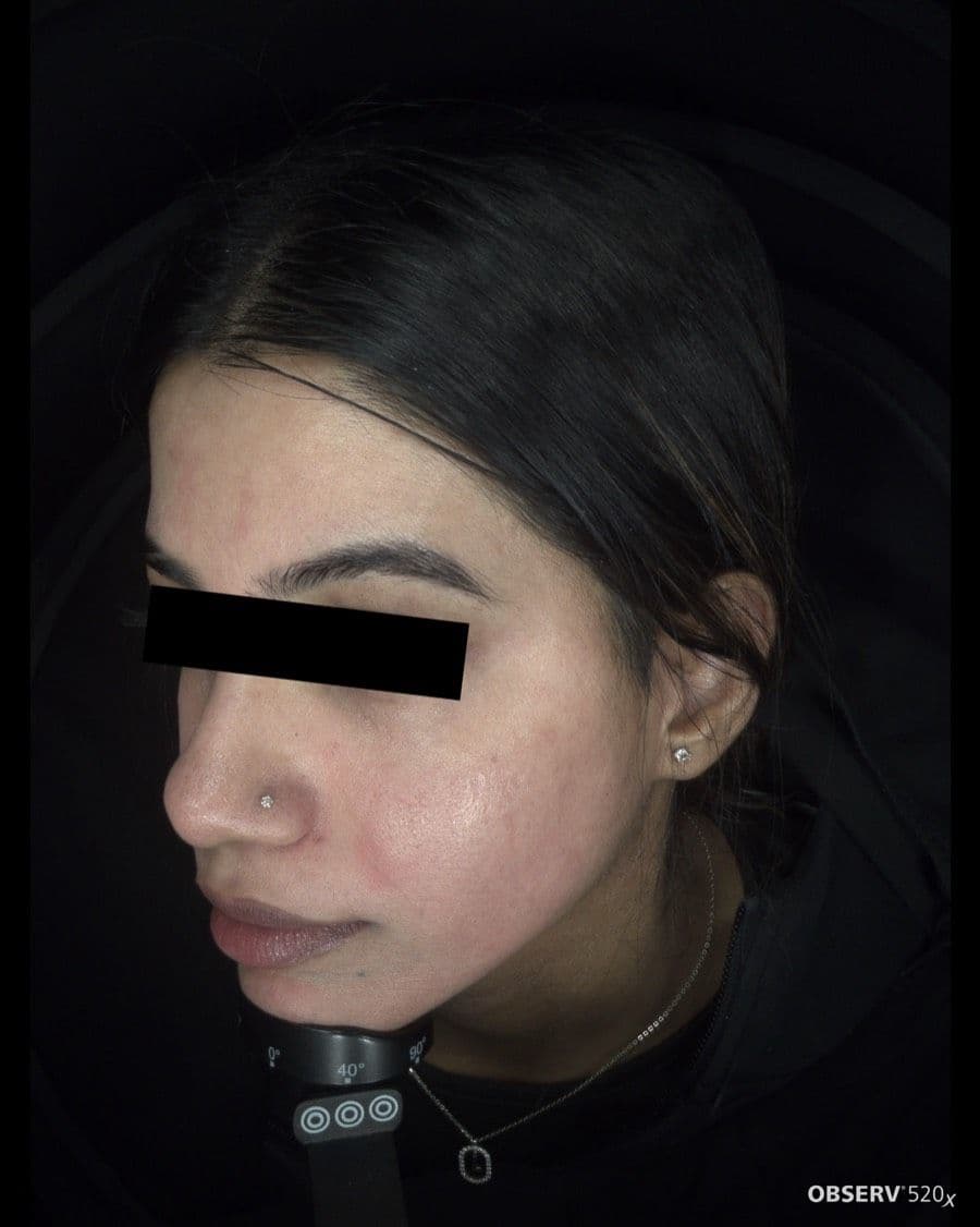 Acne & Pigmentation Treatment — After