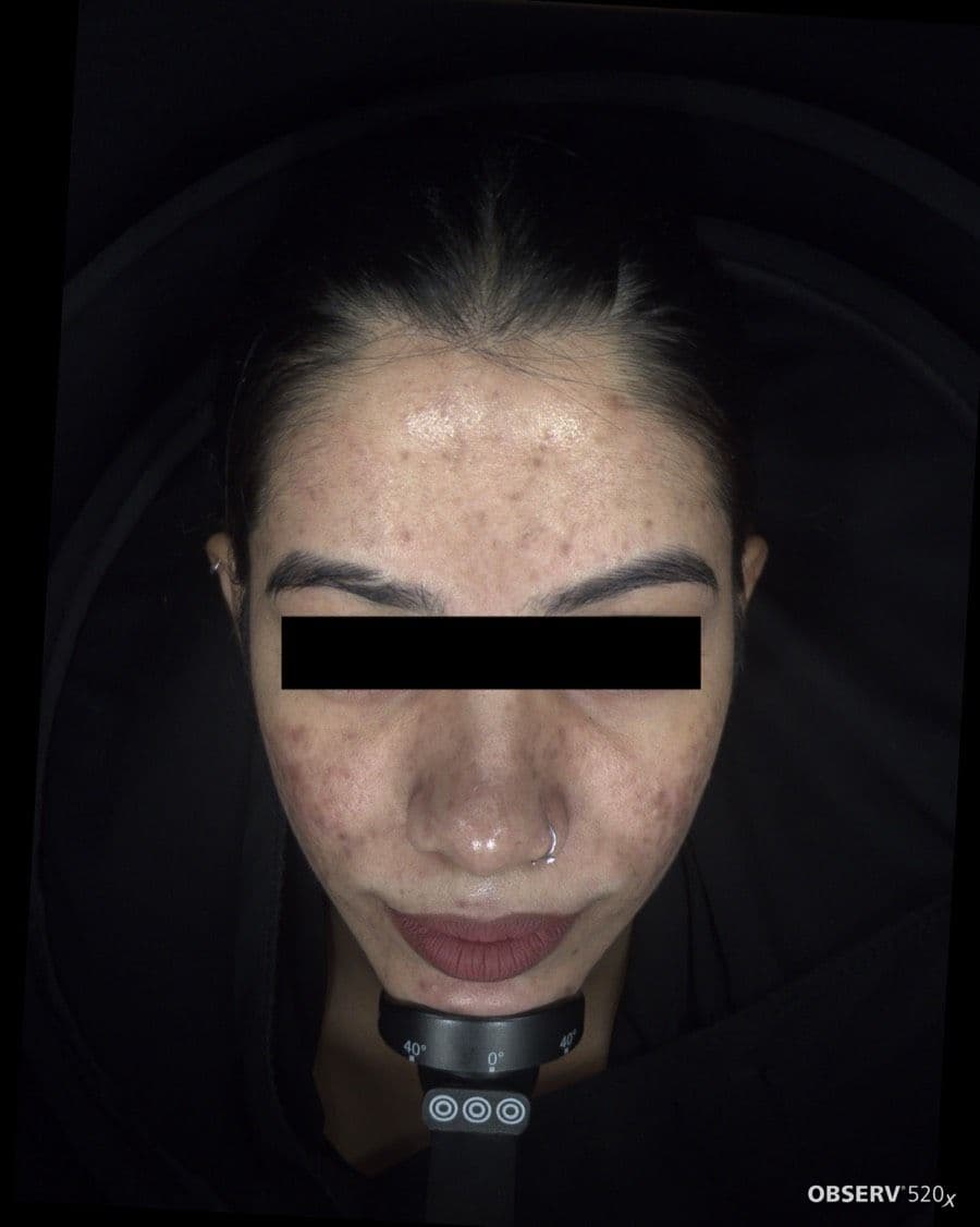 Before Acne & Pigmentation Treatment treatment