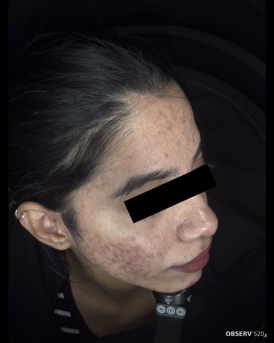 Acne & Pigmentation Treatment — Before