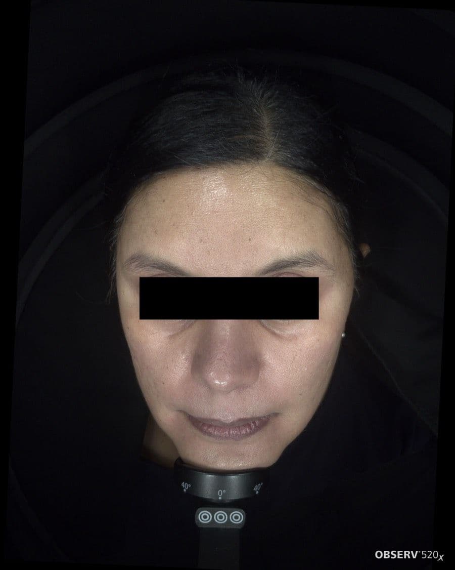 After Acne & Pigmentation Treatment treatment