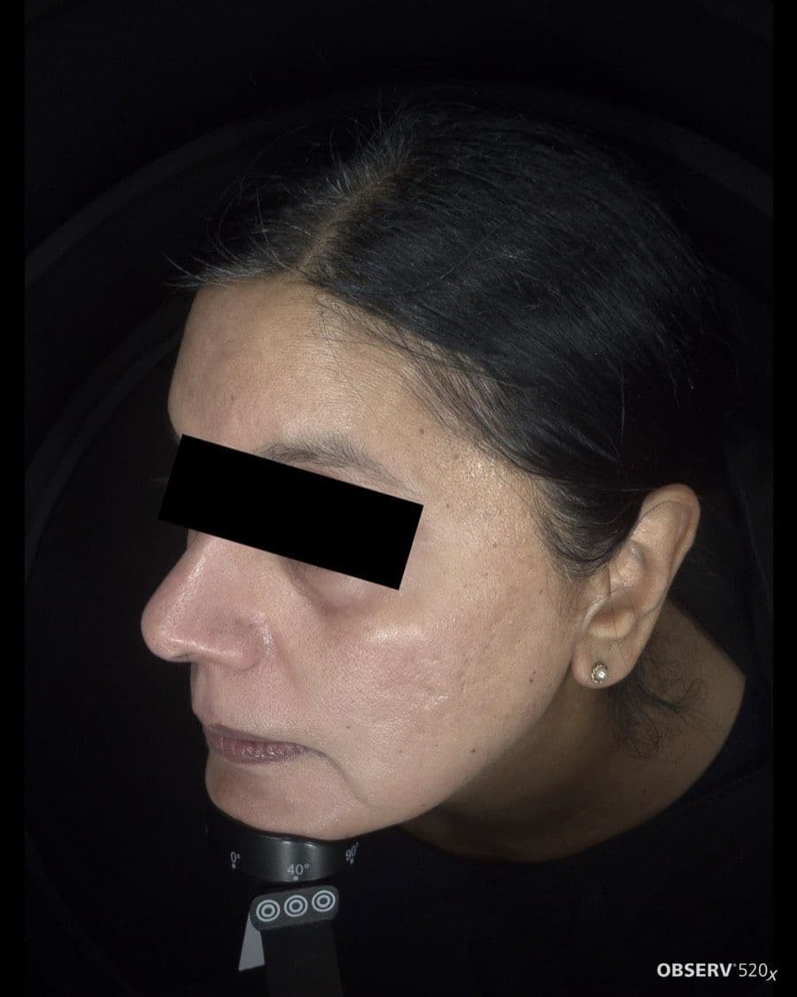 After Acne & Pigmentation Treatment treatment