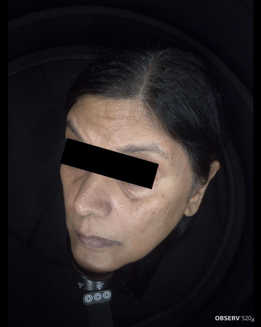 Before Acne & Pigmentation Treatment treatment