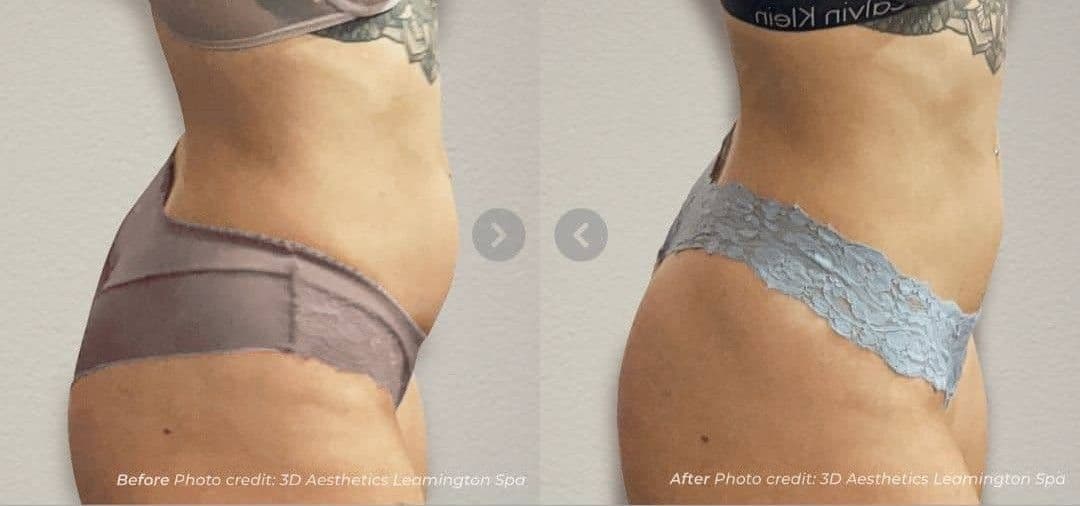 Fat Reduction before and after results