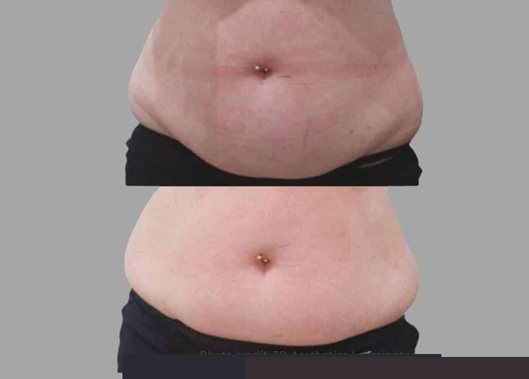 Fat Reduction before and after results