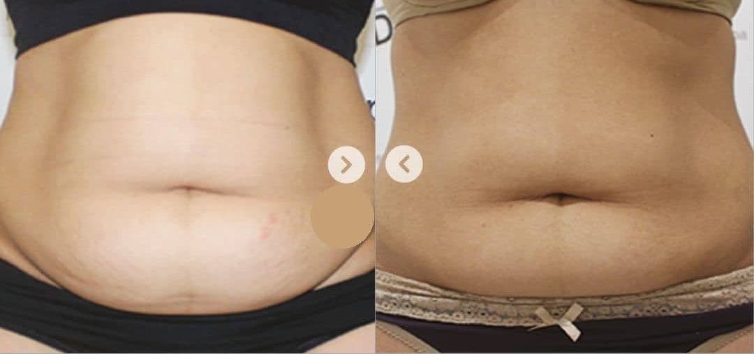 Body Contouring before and after results