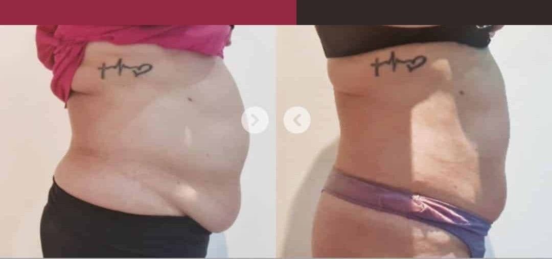 Fat Reduction before and after results