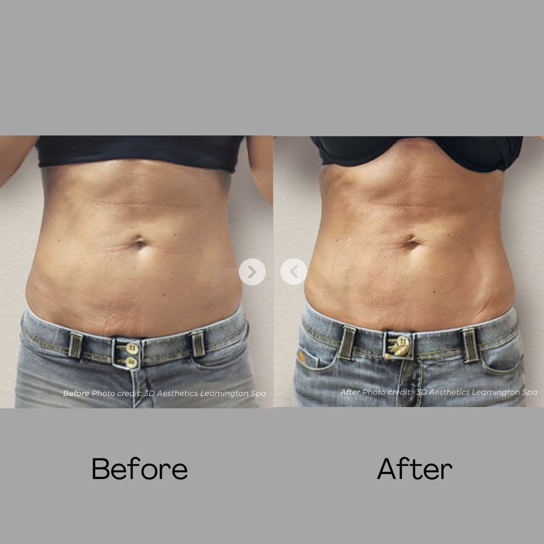 Muscle Toning before and after results