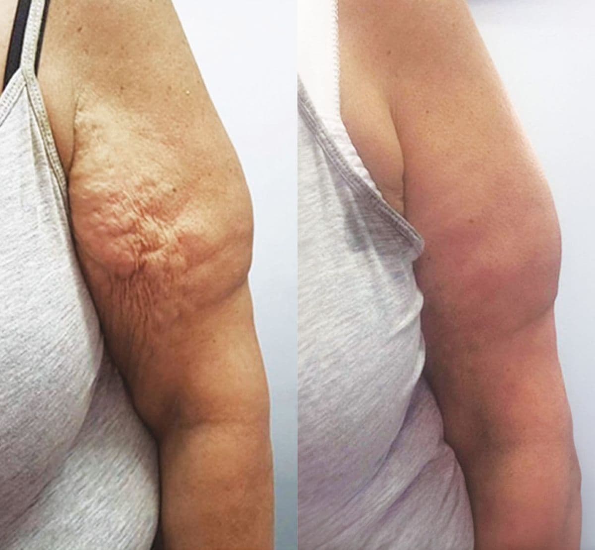 Body Contouring before and after results