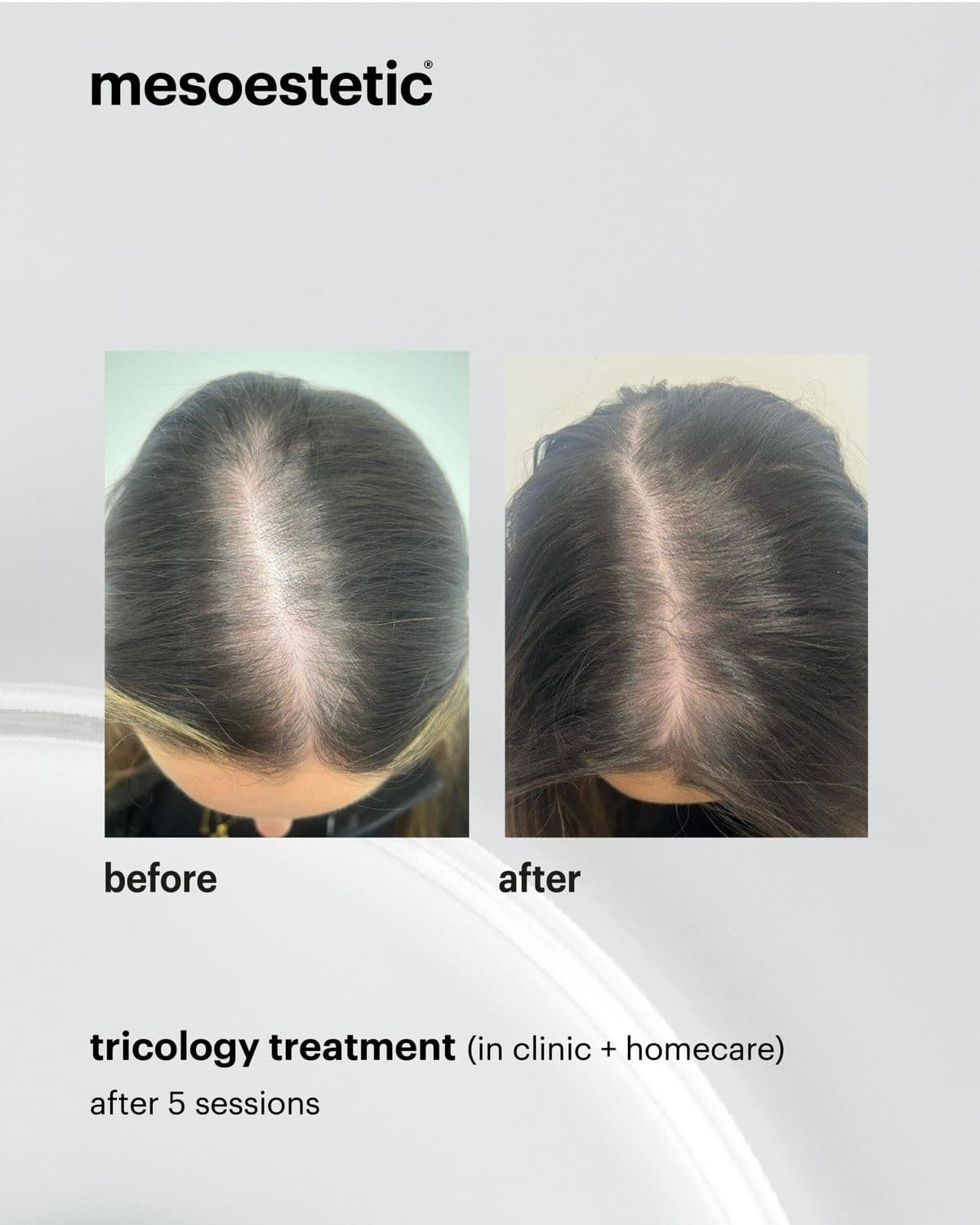 Hair Loss Treatment before and after results