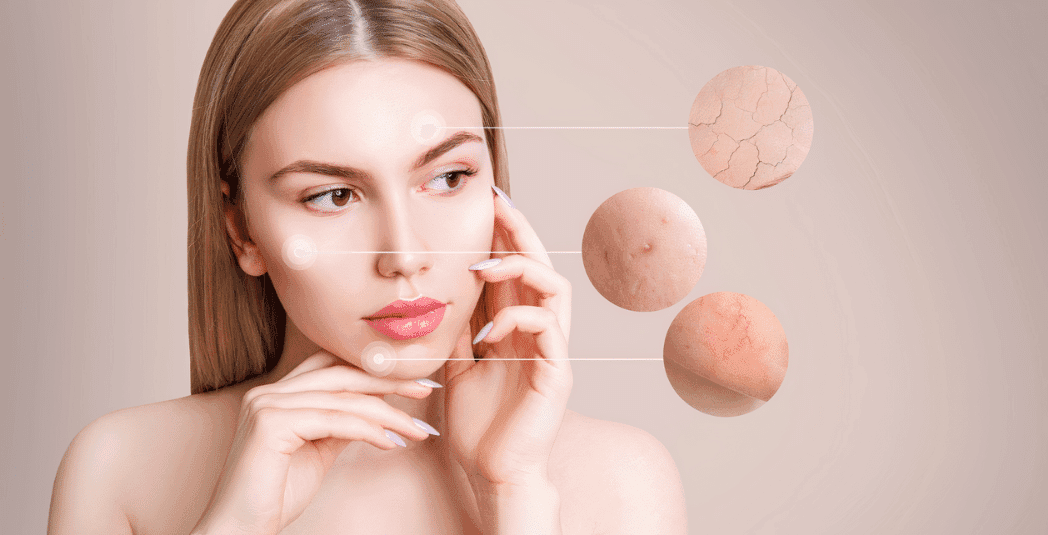 Rosacea Treatment